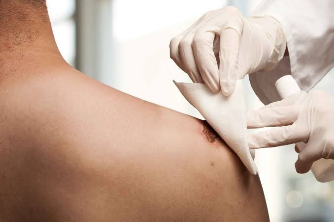 Guía Definitiva de Prevención de Escaras en Casa: Cuidados y Consejos Enfermera aplicando gasa y tratamiento antiséptico en úlcera por presión en el hombro de un paciente
